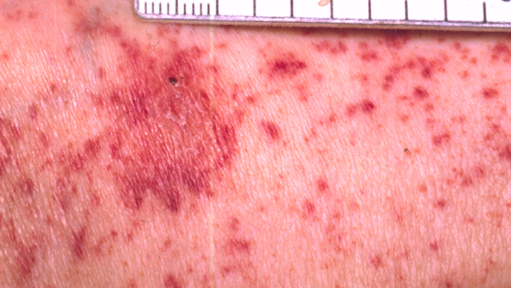 Fiebre manchada de las rocosas.jpg