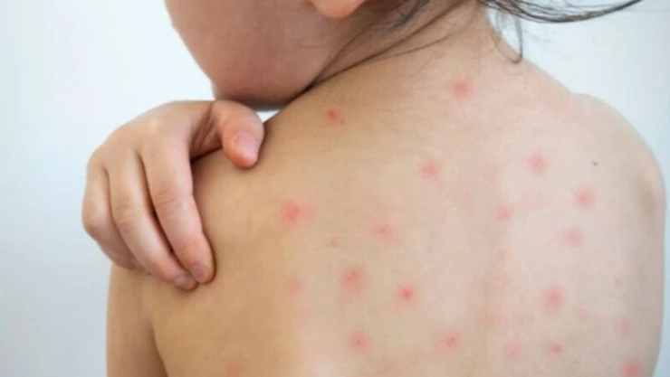 sarampion-cuales-son-sintomas-que-hacer-enfermas.jpg