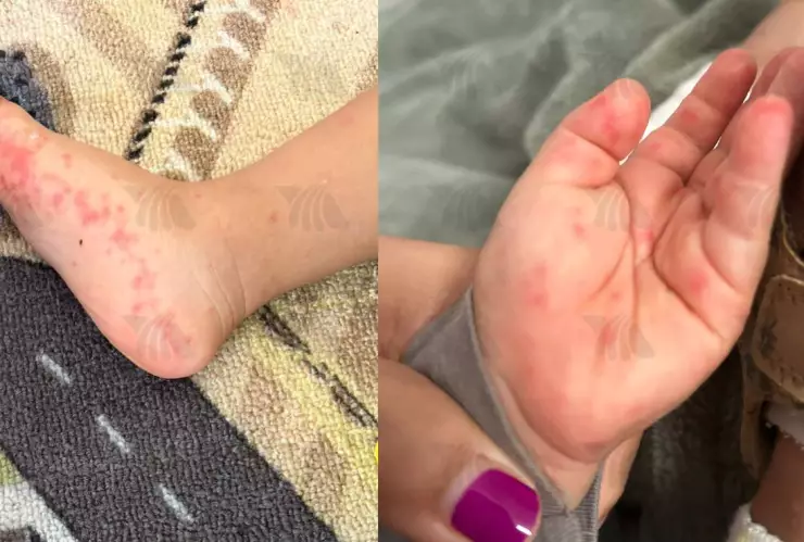 Repuntan casos de mano, pie, boca en niños de Yucatán; estos son los síntomas
