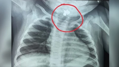 Bebé de 10 meses aspiró un anillo: el diagnóstico tardío que pudo terminar en tragedia