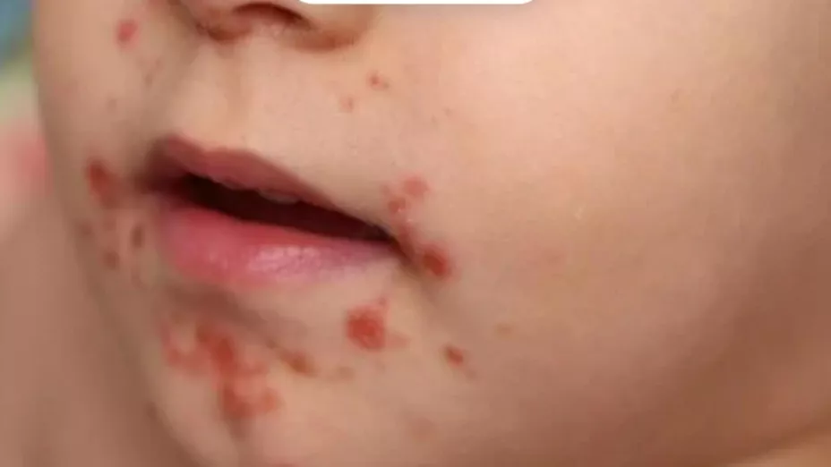 ¿Qué hacer si tu hijo se contagió de virus coxsackie en Baja California.jpg