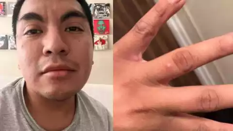 Maestro mexicano se contagia de viruela del mono y pide ayuda