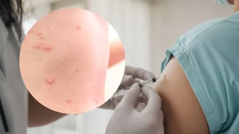 Vacuna contra el sarampión en CDMX