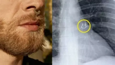 Creyó que era neumonía, tenía piercing en pulmones.jpg