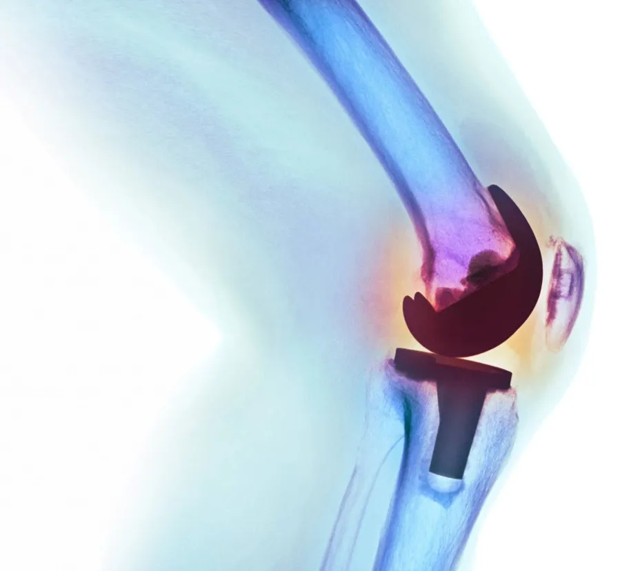 Reemplazo de rodilla Flow.jpg