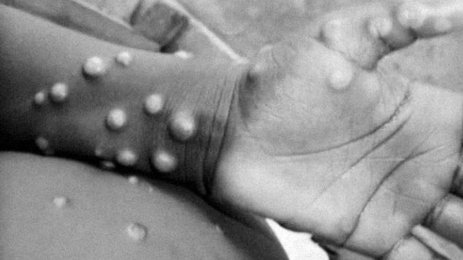 ¿Cómo prevenir el contagio de la viruela del mono