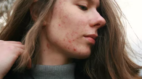 3 formas de utilizar la vaselina para eliminar las manchas del rostro