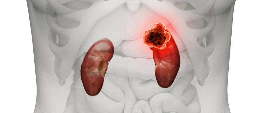 Cáncer de riñón Flow.png