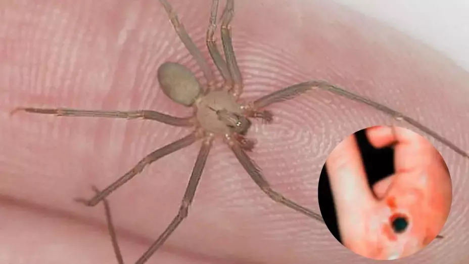 Mordedura araña violinista