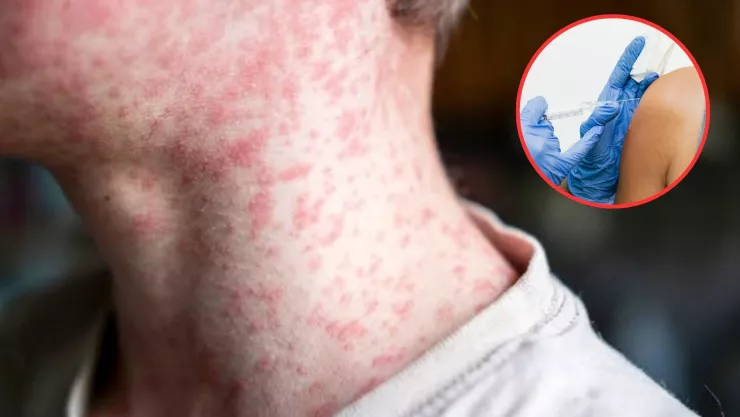 Vacunación contra el sarampión en Guadalajara: ¿Qué documentos necesito?