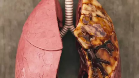 ¡Cuidado! Esta enfermedad podría destruir tus pulmones; es la cuarta causa de muerte en el mundo