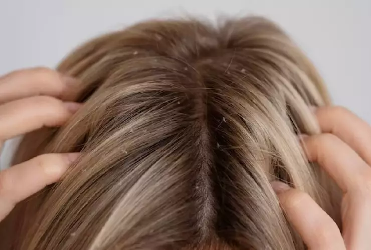 Mamá no le quita piojos a su hija porque es vegana y no mata animales