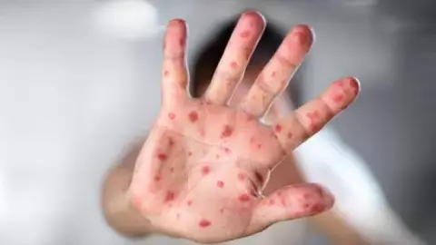 Aumentan los casos de viruela del mono en Quintana Roo; así los contagios de mpox.jpg