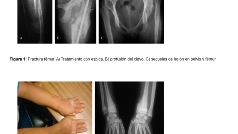 Insensibilidad-congénita-al-dolor