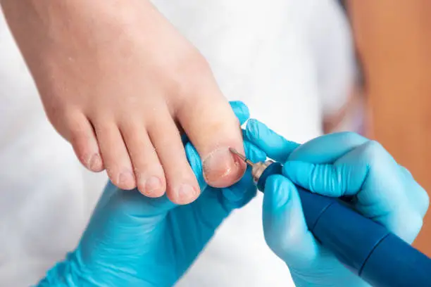 ¿Cuándo preocuparse por las uñas gruesas?
