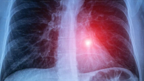 Aumentan casos de tuberculosis respiratoria en México