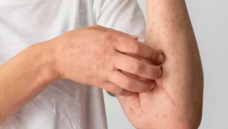 Alerta sanitaria: 31 muertes por sarampión y más de 2 mil niños contagiados