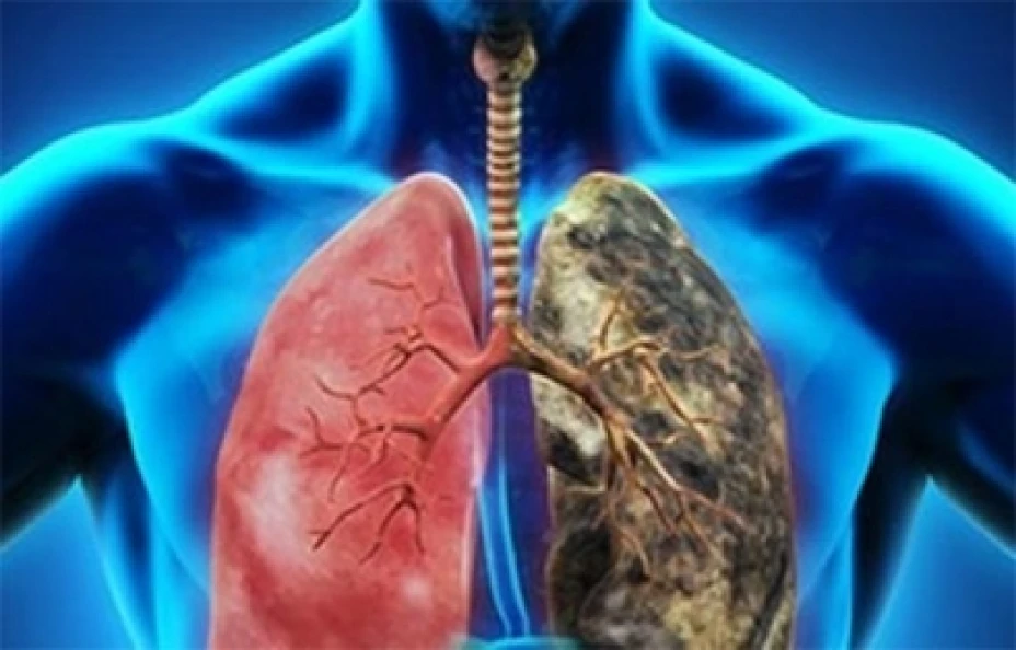 Cáncer de pulmón