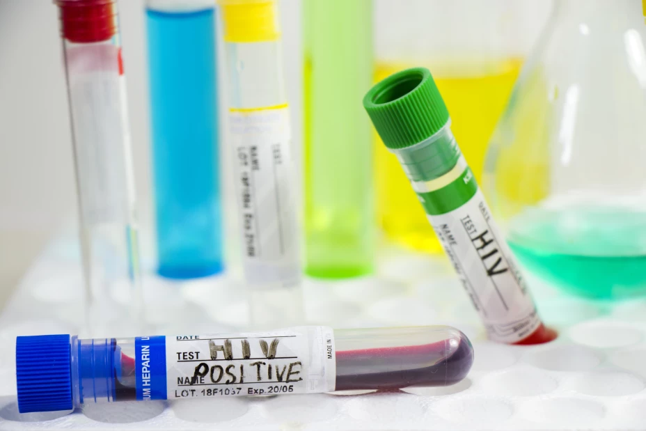 Hiv and aids infection blood test sample, diagnoses and laboratory chemical liquid elements