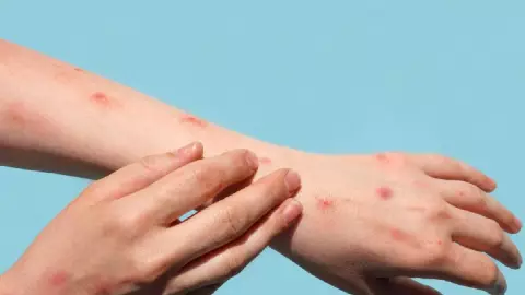 viruela del mono y varicela.jpg