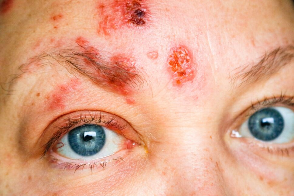 mujer con culebrilla herpes zoster en el rostro