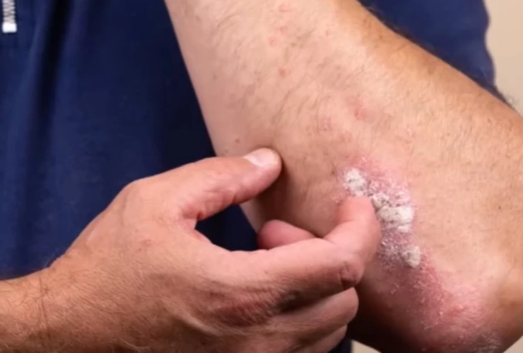 Fumar-desarrolla-riesgo-psoriasis-tabaco