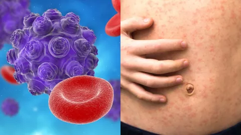 Sarampión en México.jpg