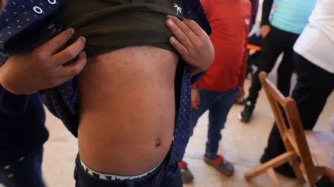 sarampion muerte méxico