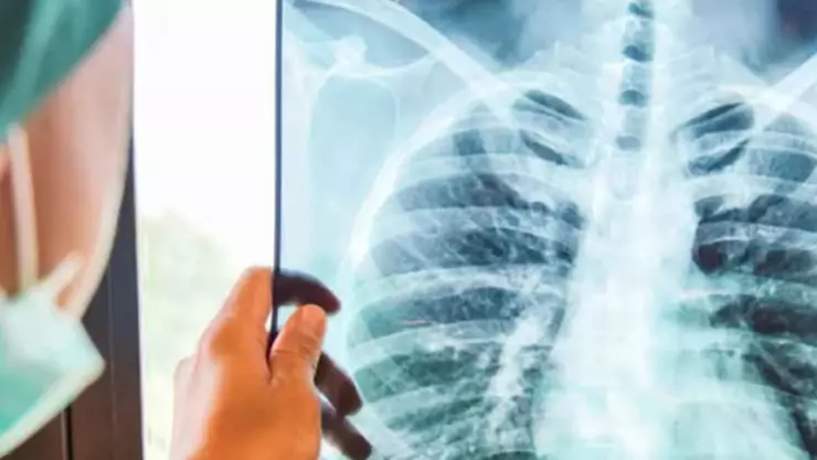 tuberculosis Chihuahua