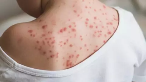 Sarampión en Yucatán: ¿Cuánto tiempo dura el VIRUS en las superficies?; lo que debes de saber