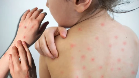 Brote masivo de sarampión: ¿Qué es y cómo se contagia y cuáles son los síntomas de esta enfermedad?