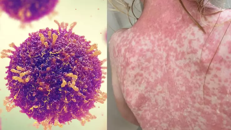 Confirman más de 10 casos de Sarampión en Quintana Roo: Municipios con contagios; síntomas y prevención