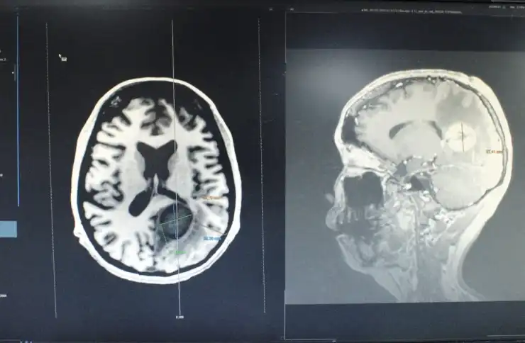 Extirpan tumor cerebral a paciente despierta en el ISSSTE