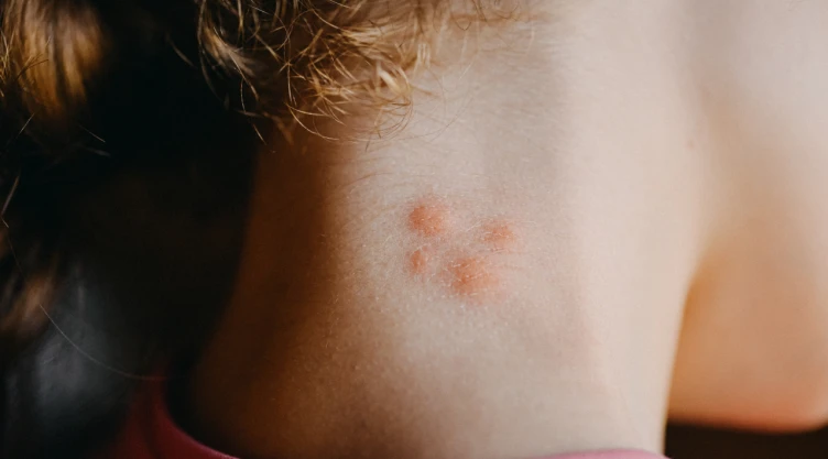 Cómo diferenciar piquetes de mosquitos, chinches, pulgas y otros insectos
