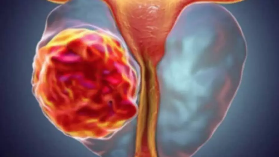 Día Mundial del Cáncer de Próstata ¿Cómo prevenirlo?