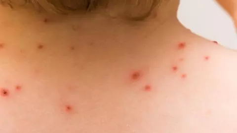 Reportan segundo caso de viruela del mono en Quintana Roo