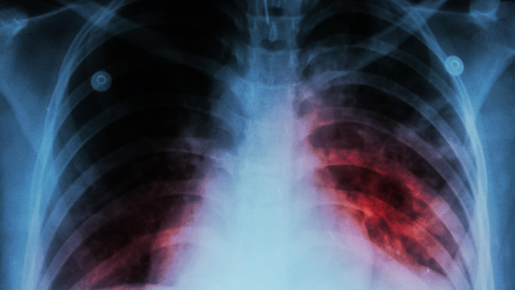 Tuberculosis aumenta en Chihuahua