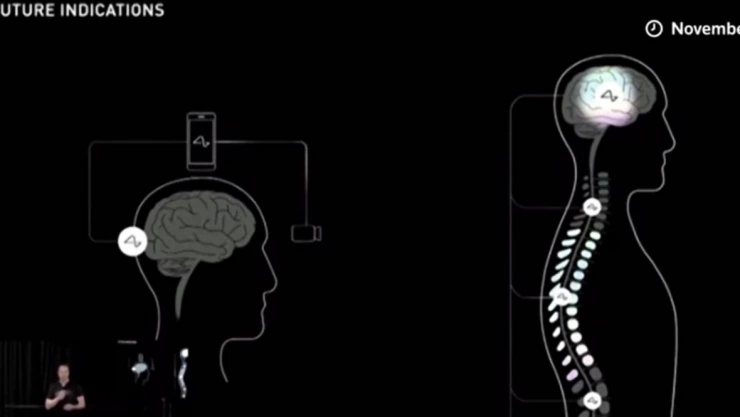 Implante cerebral de Elon Mu