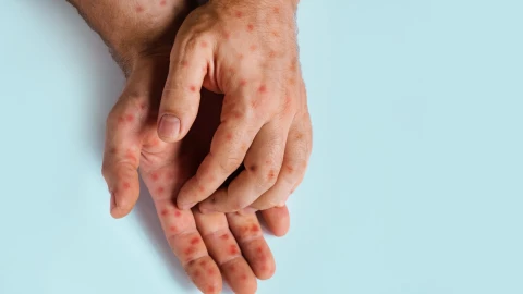 Unas manos con signos de sarampión.