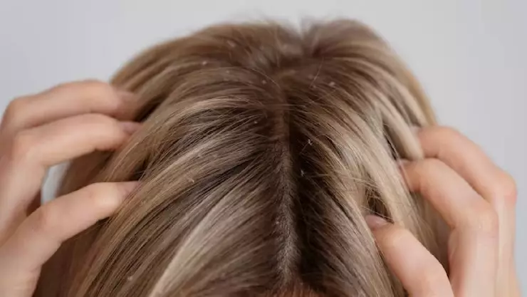 Mamá no le quita piojos a su hija porque es vegana y no mata animales