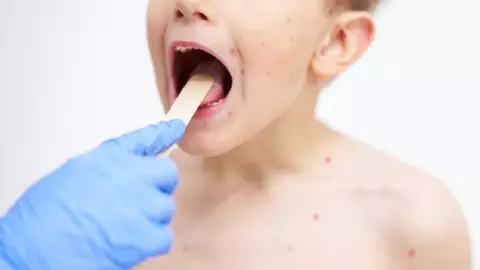 ¿Qué diferencias hay entre viruela del mono y la varicela.