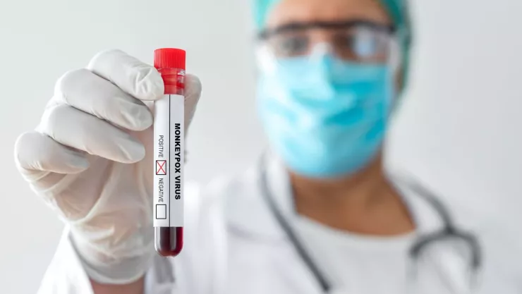 No desapareció: La Viruela del Mono tiene en alerta a estos países