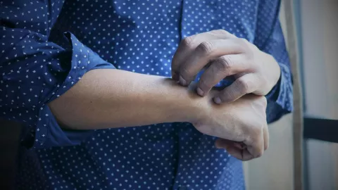 Viruela del Mono estas son las secuelas que podrías experimentar.jpg