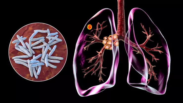 Tuberculosis en México: Estados en donde hay mayor número de casos