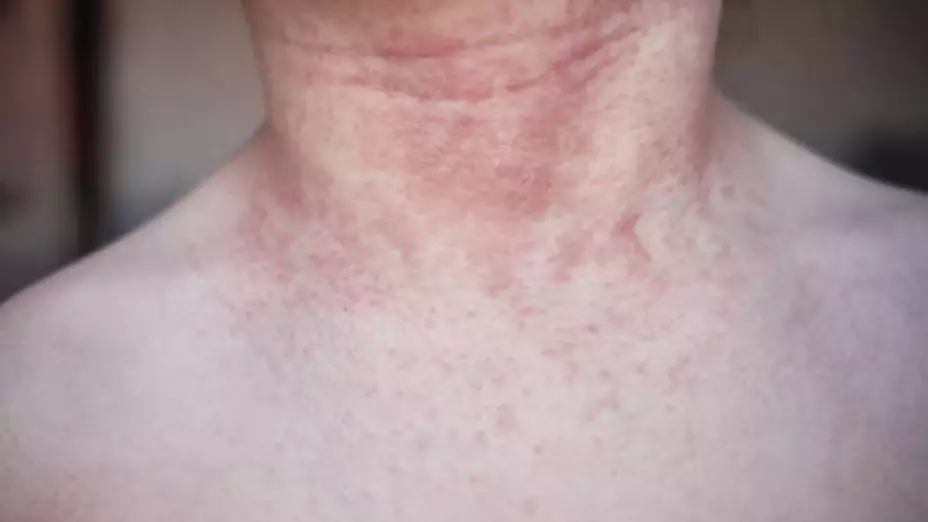 Fiebre manchada