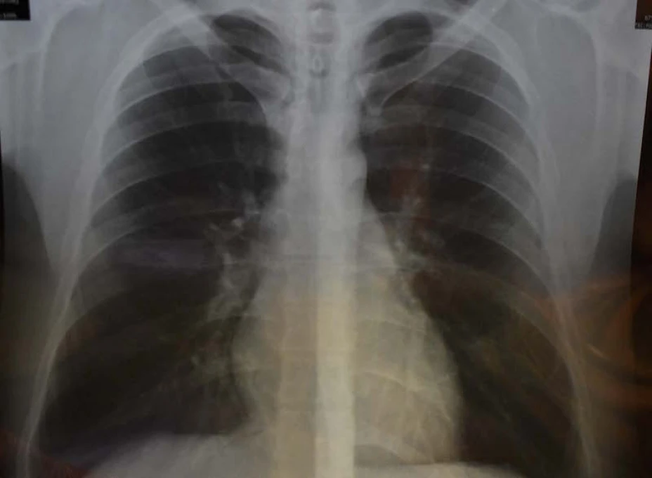 Cáncer pulmón