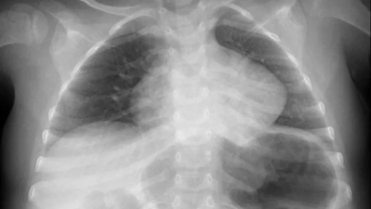 niña de dos años se traga una pila y explota en su estómago en paraguay.jpg