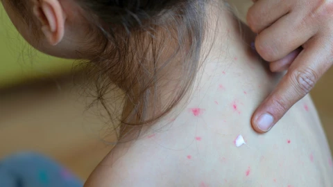 Síntomas del sarampión