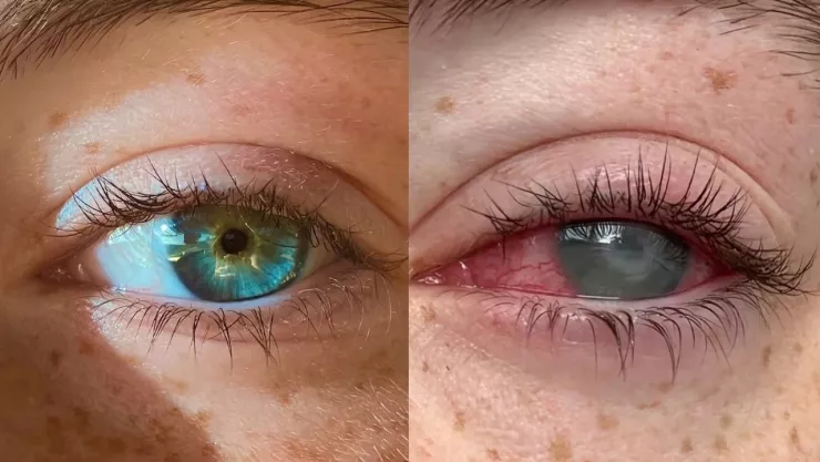 Joven pierde la vista tras bañarse con lentes de contacto; caso se vuelve viral