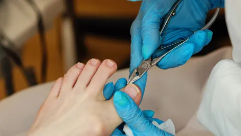 hongos uñas